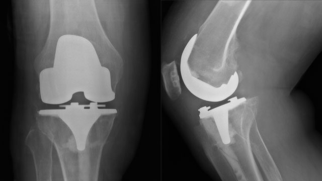 zimmer-knee-recall