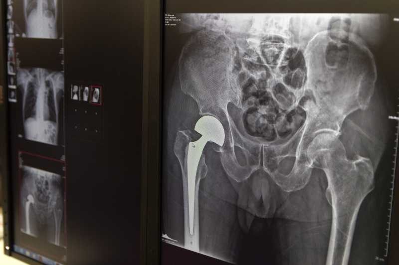 bigstock-X-ray-Of-The-Hip-Prosthesis-El-356977013